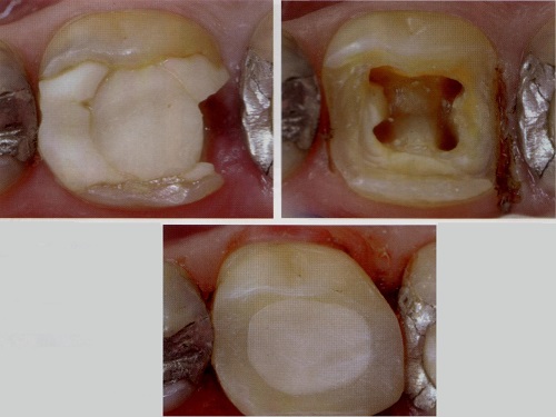 Implantes